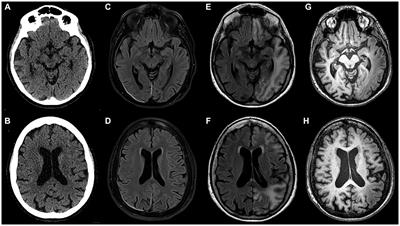 Case report: Late onset type 3 hemiplegic migraine with permanent neurologic sequelae after attacks